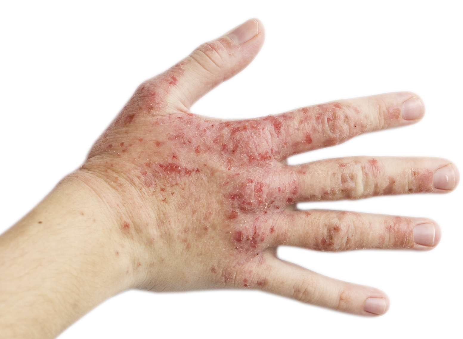 A patient with psoriasis