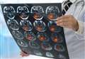 Shutting stroke units in hospitals 'makes no sense'