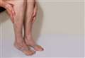 Medical expert to give talk about varicose veins