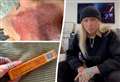 ‘I ended up in A&E in excruciating pain after using tattoo cream’