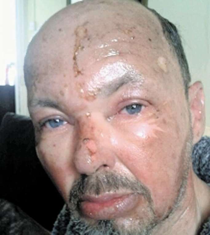 Angler Stuart Roberts suffered horrific burns when a gas canister exploded in his face