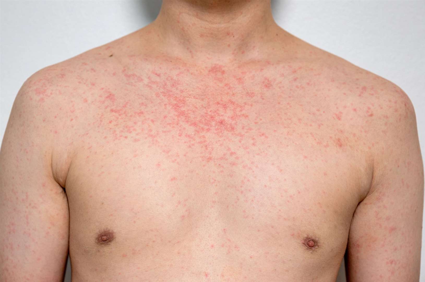 After initial cold-like symptoms patients develop a rash. Image: iStock.