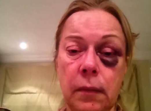 Surrey Police have launched an investigation called Operation Prometheus to catch who they believe is a military man behind a string of violent burglaries. Susan Morris was left with a black eye during the ordeal.