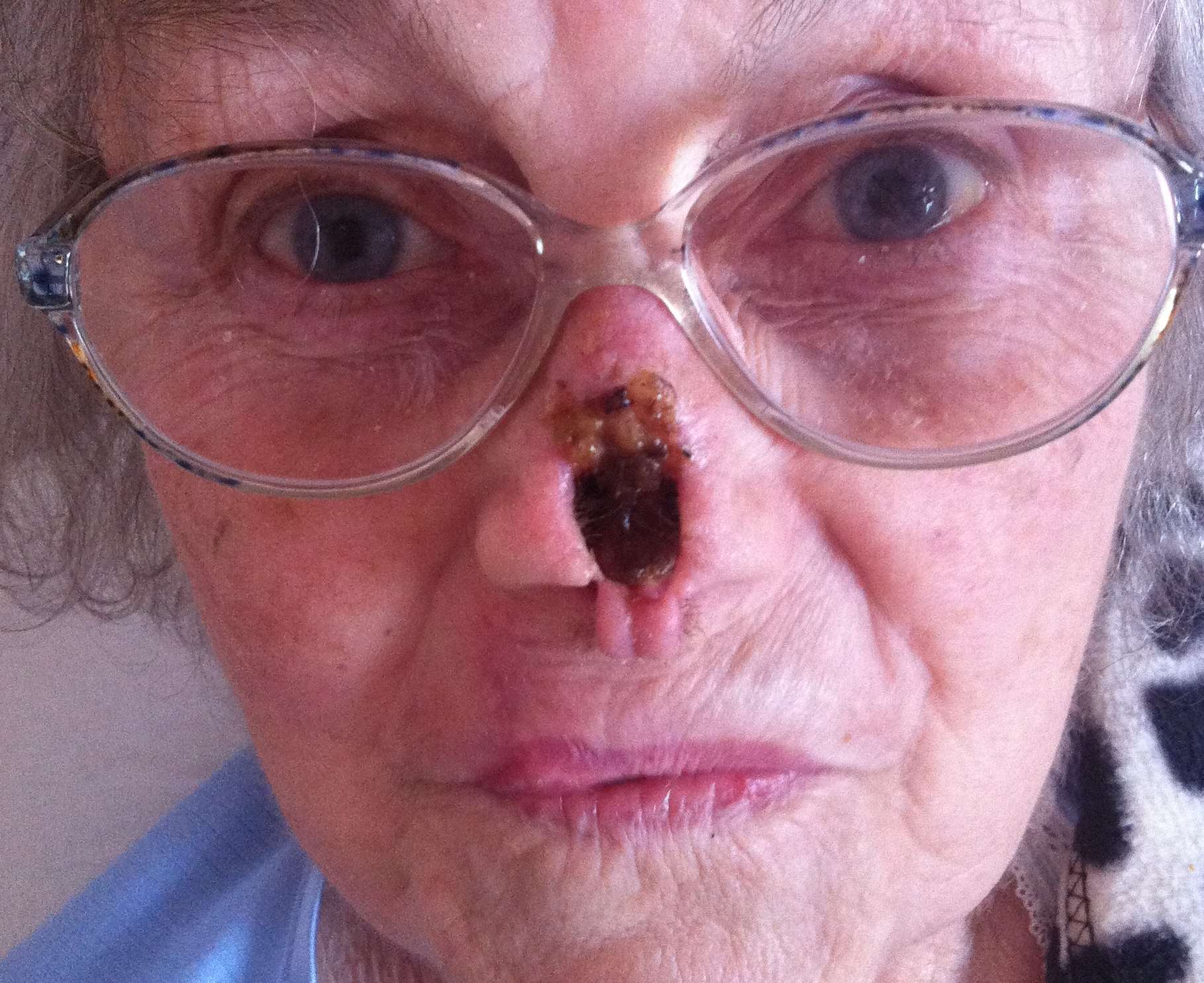 Golda has been left with a hole in her nose