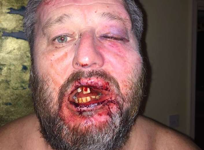 Pete Hancox's battered face after the unprovoked assault