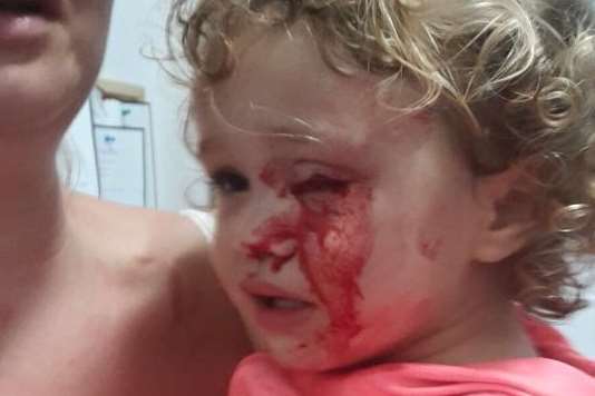Two-year-old Poppy Cooper's eye was injured on the hook