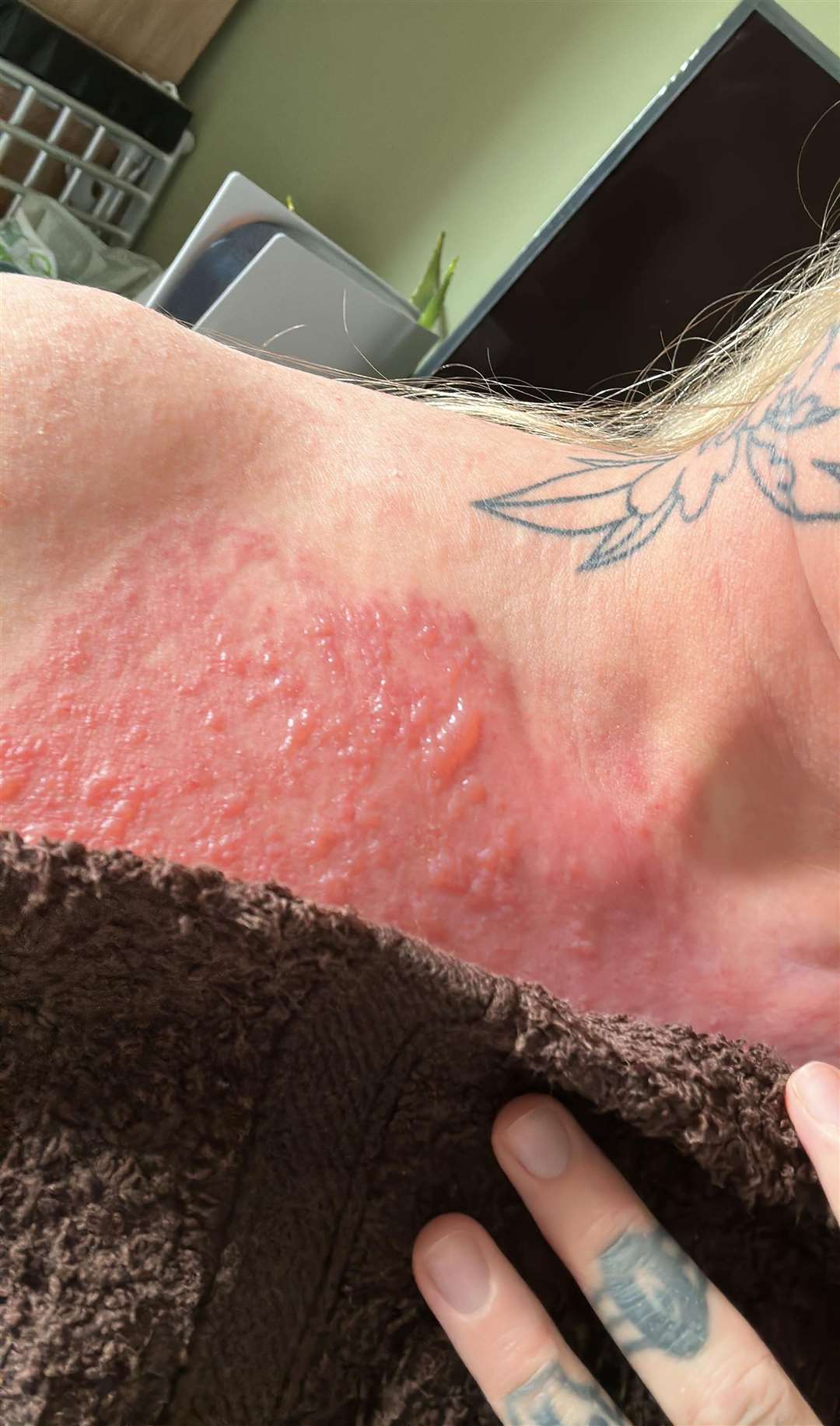 Abbie Smith's chest came out in blisters after using a fake numbing cream before a tattoo appointment. Picture SWNS