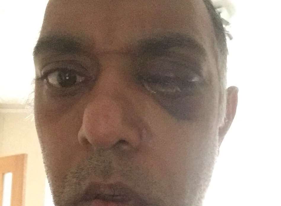 Paul Ramsamy was left blind in one eye