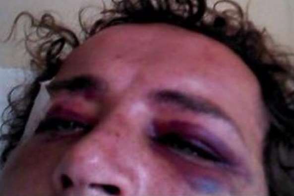 The bruised face of DJ Oliver Sebastien