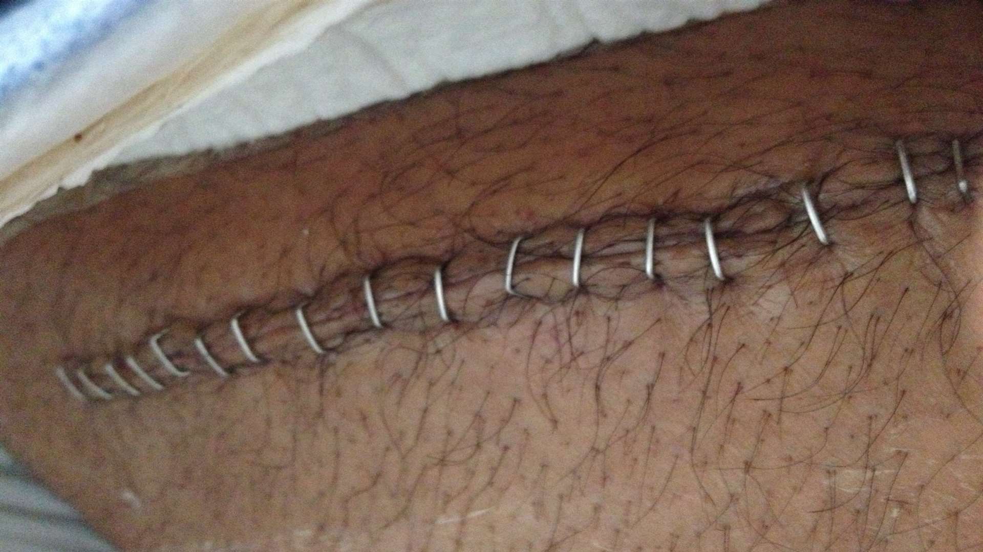 The wound to Gurdev Singh's leg, with 20 staples holding it together where doctors had to cut into the leg to stop deep bleeds