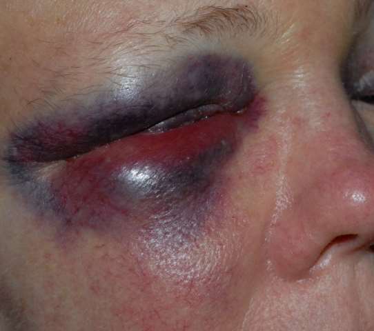 Her black eye after the appalling attack