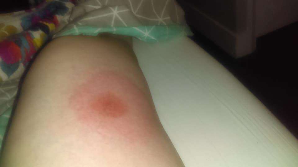Claire's tick bite resulted in a typical bulls-eye rash