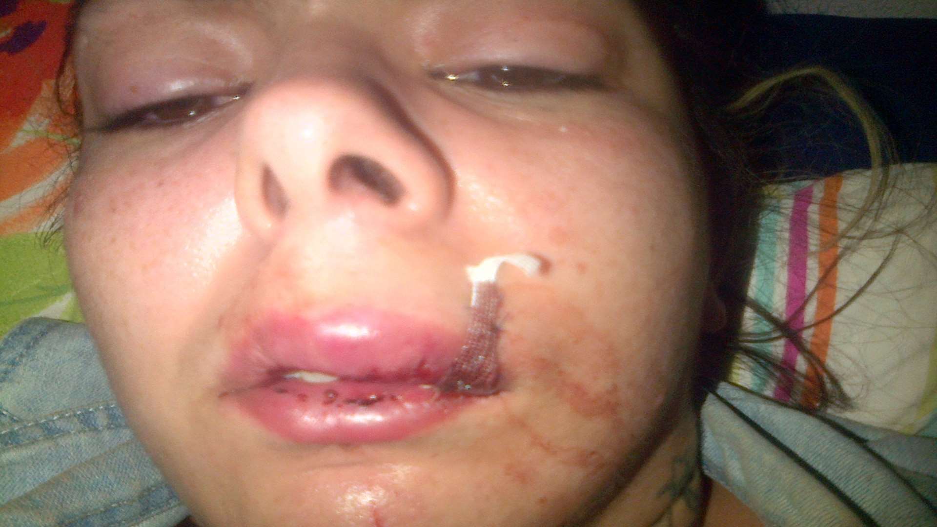 Gemma Heisley needed seven stitches after the attack
