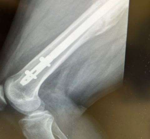 Darren Crooks was treated with a femoral nail at King’s College Hospital in London after fracturing his right thigh. Picture: Darren Crooks