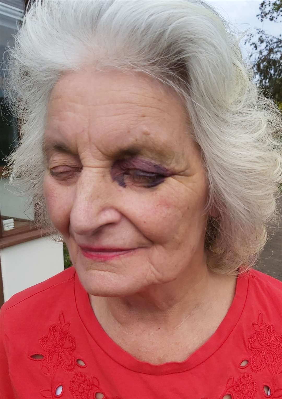 The bruise on Joan Stone's face, where a gun was held against her face