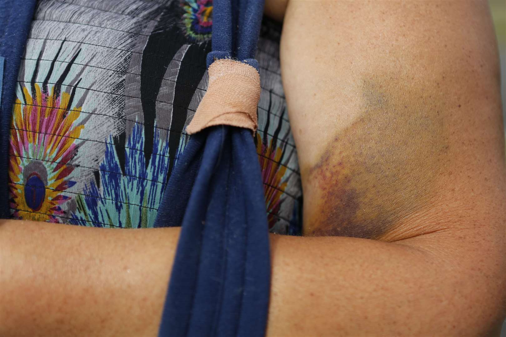 Lizette's bruised arm