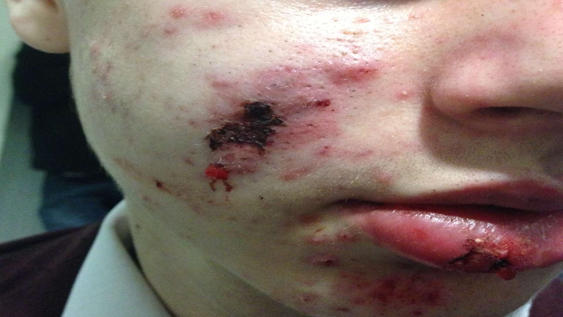A close-up of the injuries suffered by schoolboy Ethan Baber