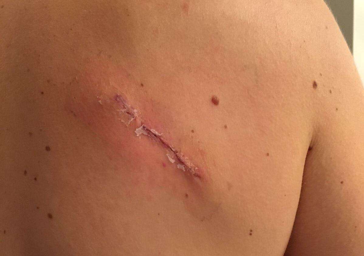 The scar left after Megan Duffield’s mole was removed