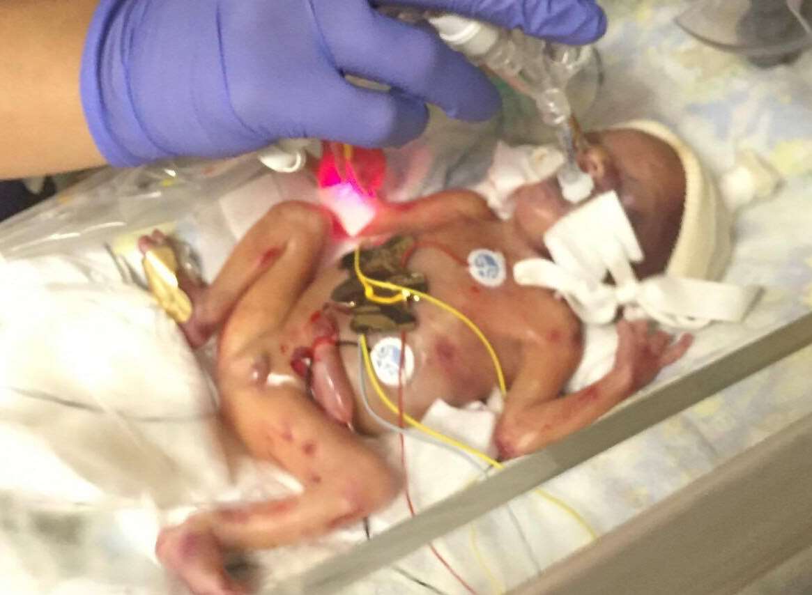 Ares needed round-the-clock treatment after he was born prematurely