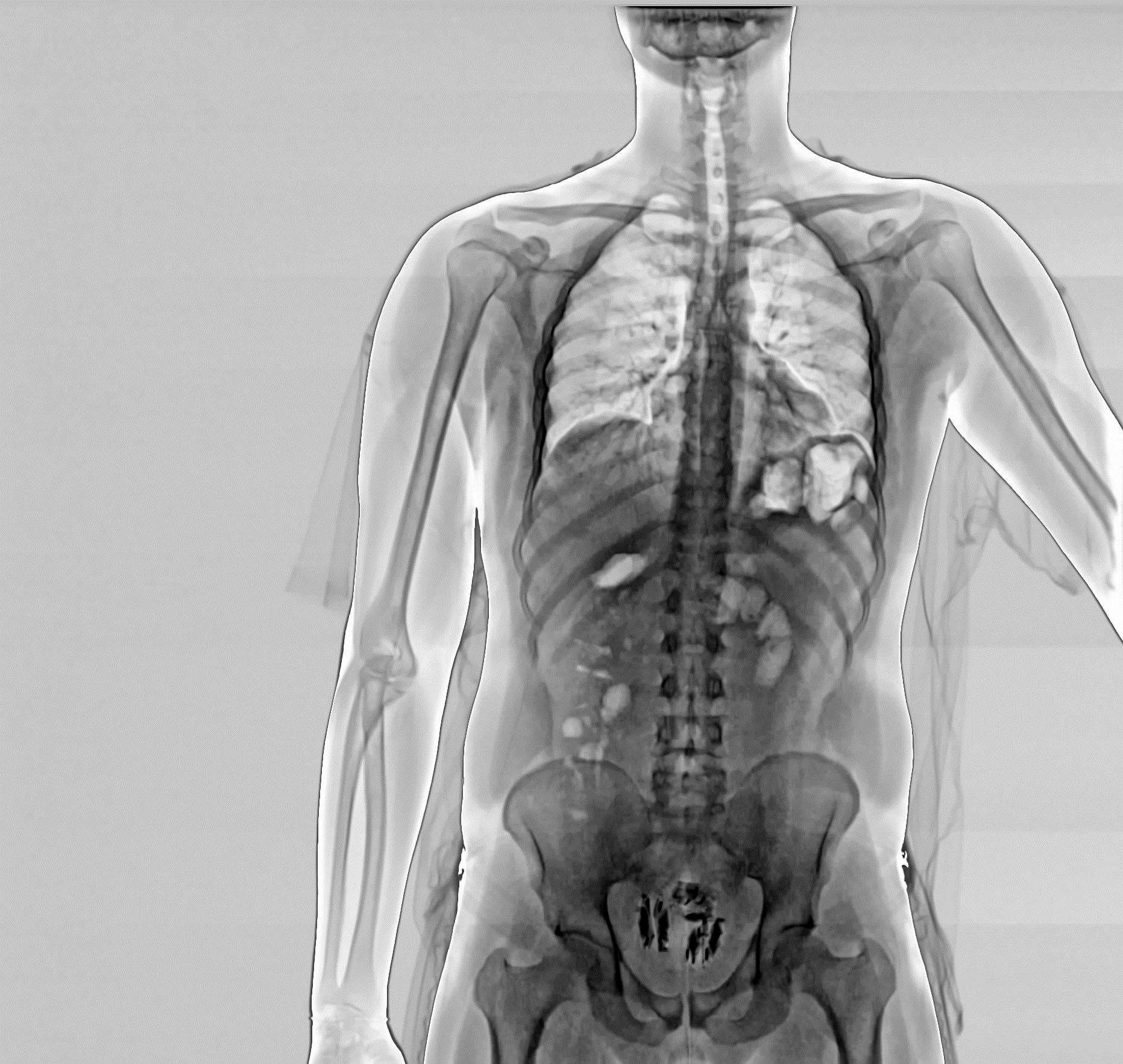 An X-ray scan on a prisoner who was attempting to smuggle four mobile phones, a bag of tobacco and several sim cards. Picture: Ministry of Justice
