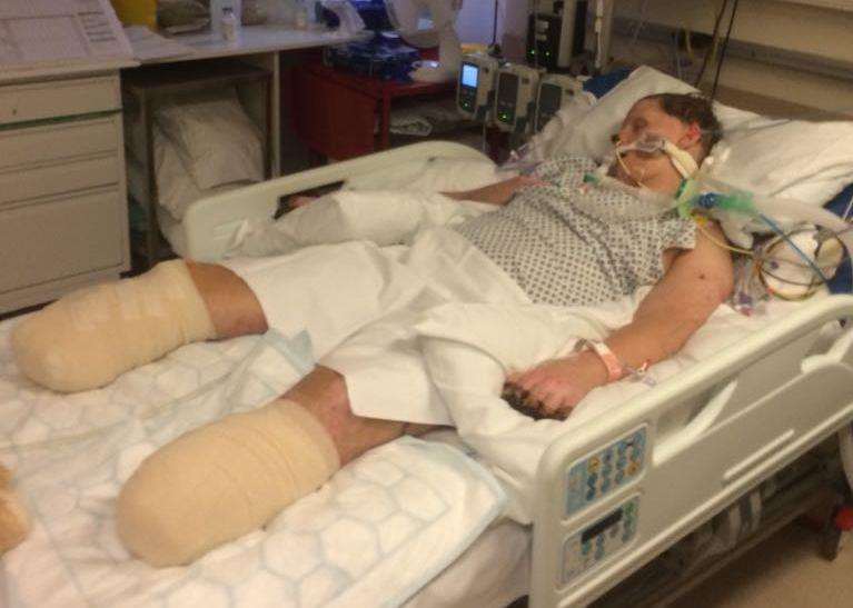 Greg Keating has had his legs and fingers amputated following a deadly case of sepsis