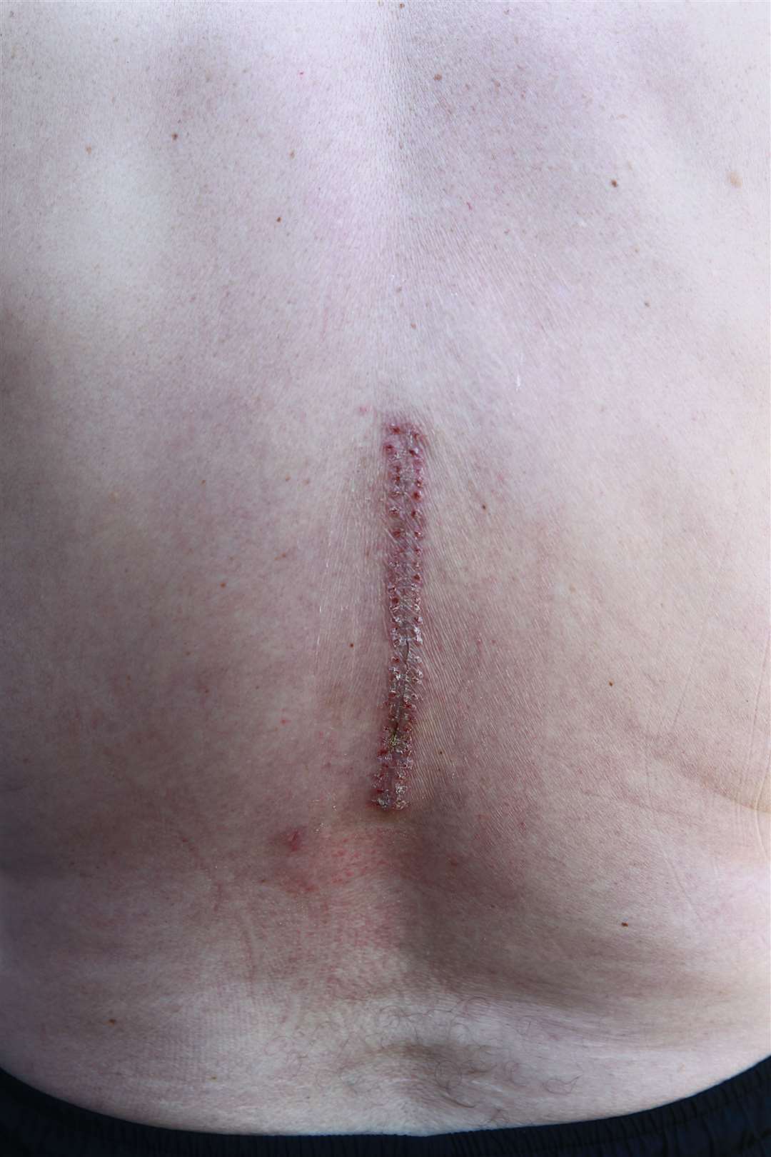 Stephen Meekins has been left with this scar after the surgery on his vertebrae. Picture: John Westhrop (14188898)