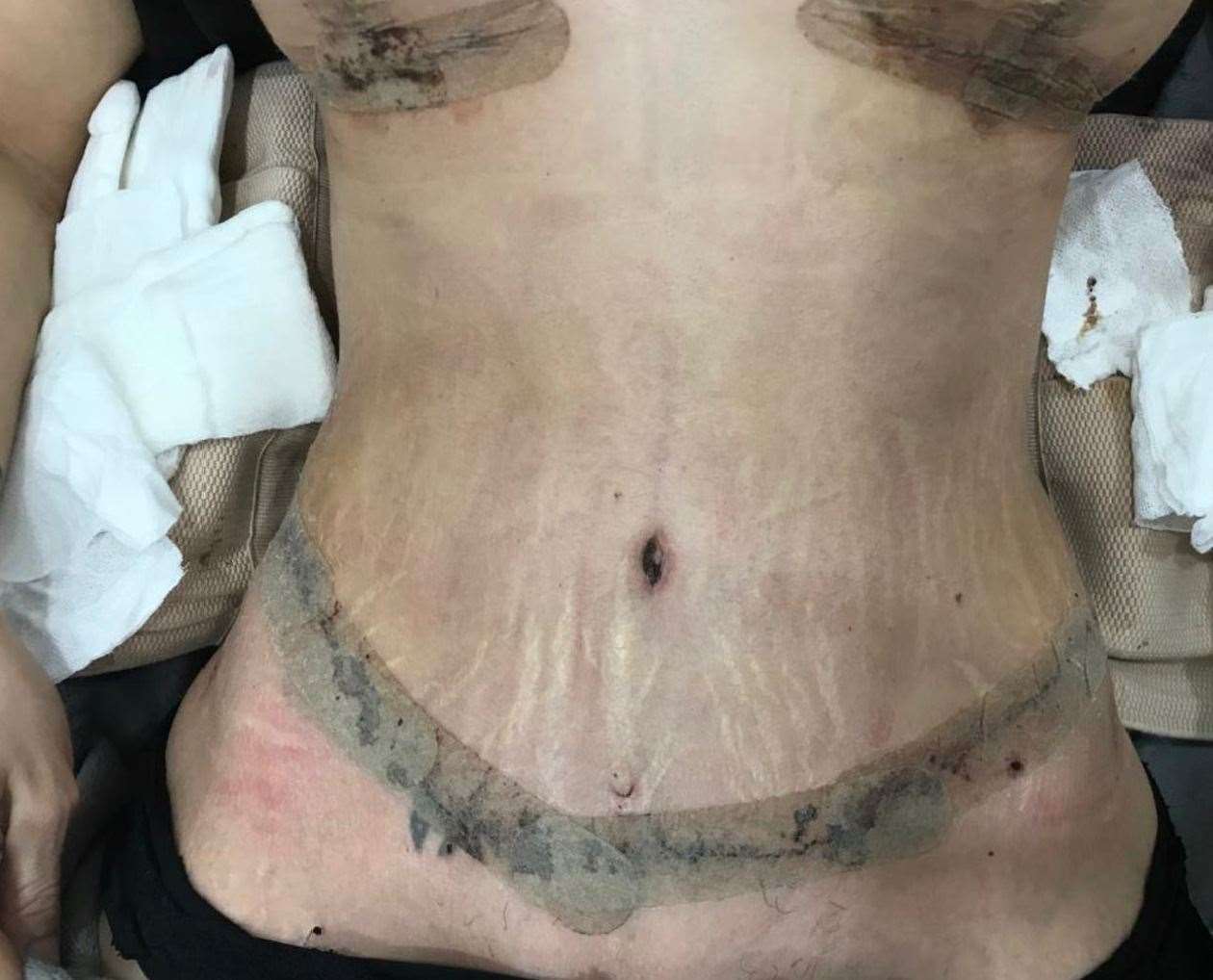 The wounds were taped up after surgery