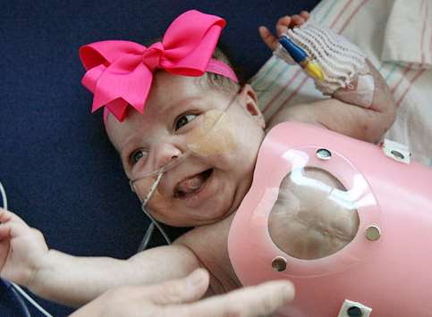 American youngster Audrina Cardenas, now two, survived having her heart tucked back inside her chest