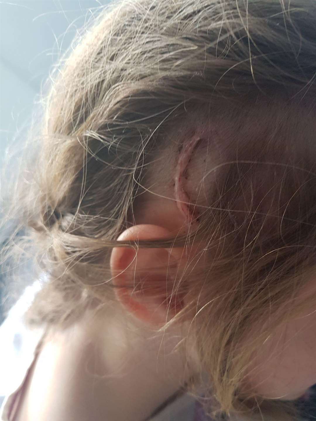 Ella-Louise Foster, 11, has been left with a scar after brain surgery (2113299)