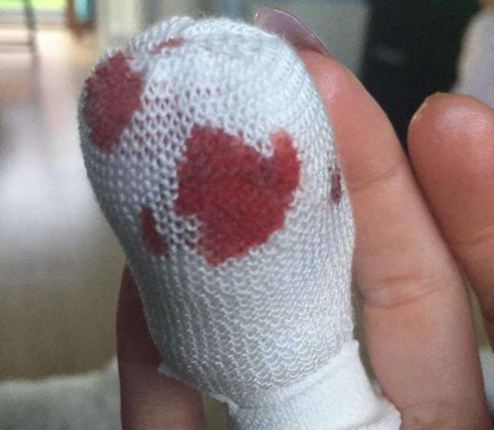 Kelly Kay's bandaged finger