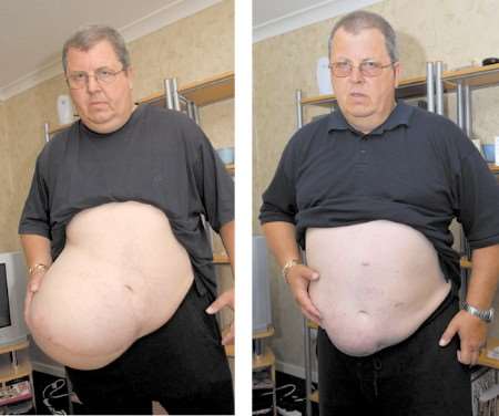 Ron Bell with his massive hernia in August 2006, and after his treatment finished in June this year