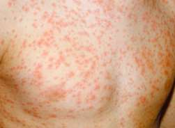 A red-pink rash is a common symptom of rubella. Pic: NHS