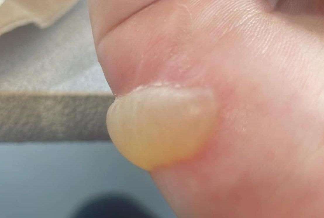 The blister on Chloe Norris' hand. Picture: Stacey Norris