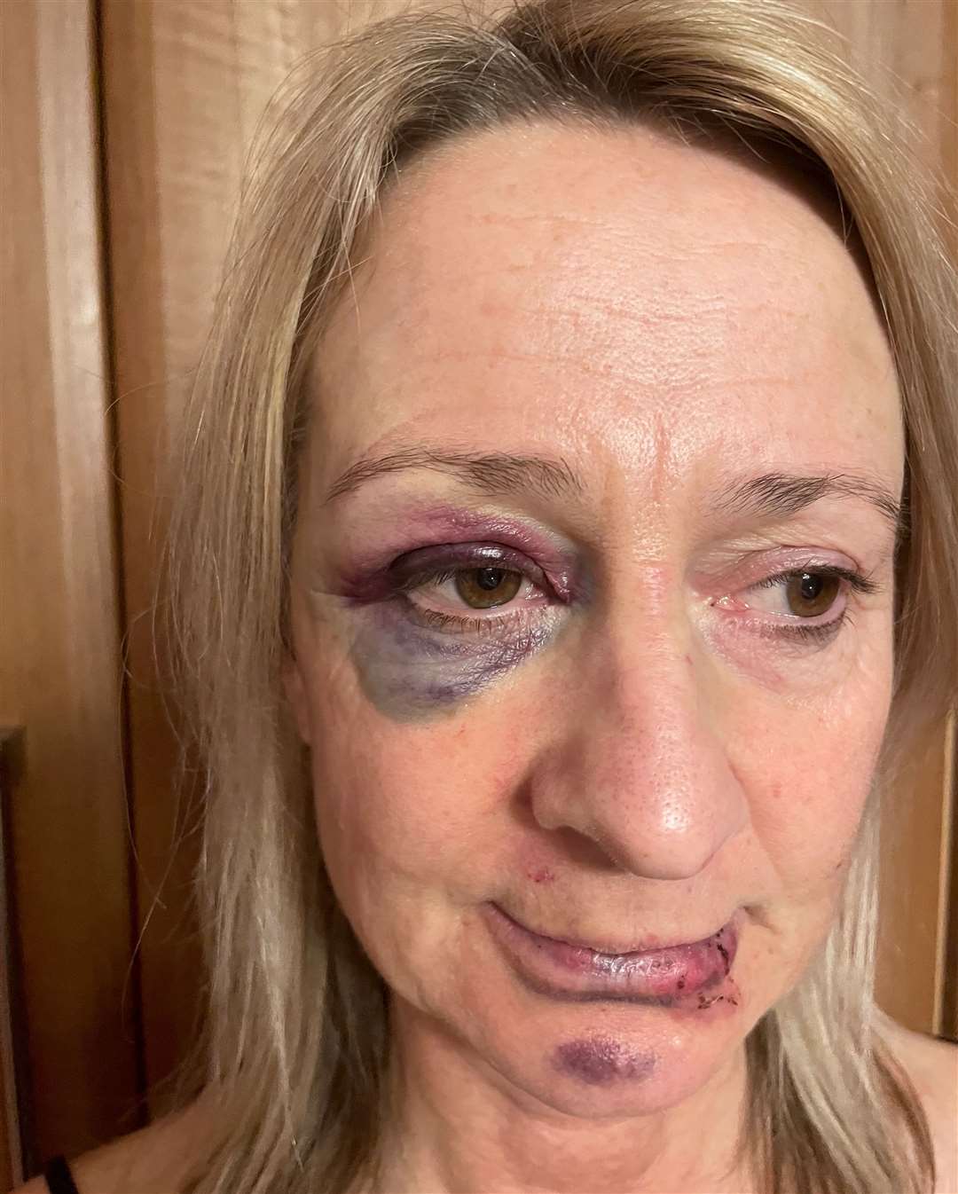 Shocking pictures show how Debbie Hook, from Deal, was battered black and blue by her sister-in-law Emma Varrall