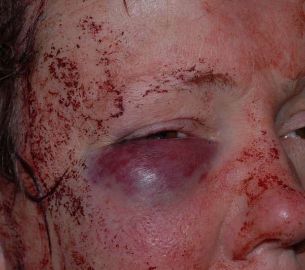 The woman's face was left bloodied and bruised