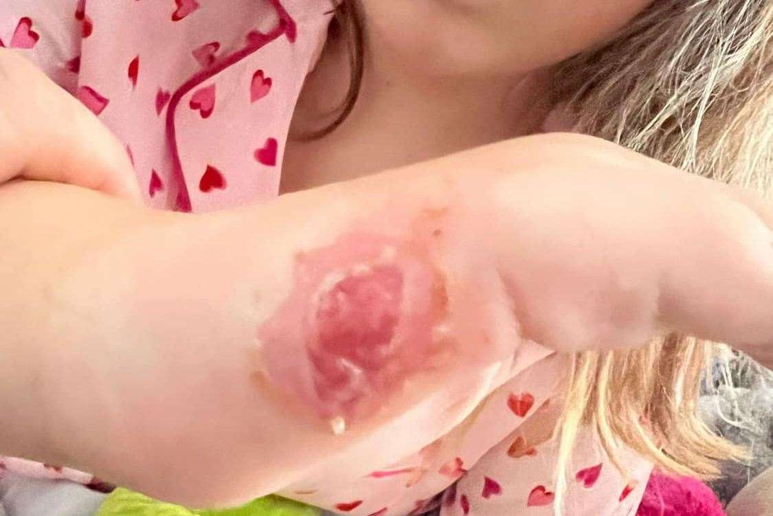 The burn on Chloe Norris' hand. Picture: Stacey Norris