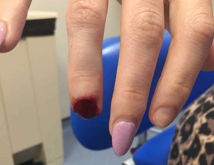Kelly's Kay's lost part of her finger after trapping it in a door