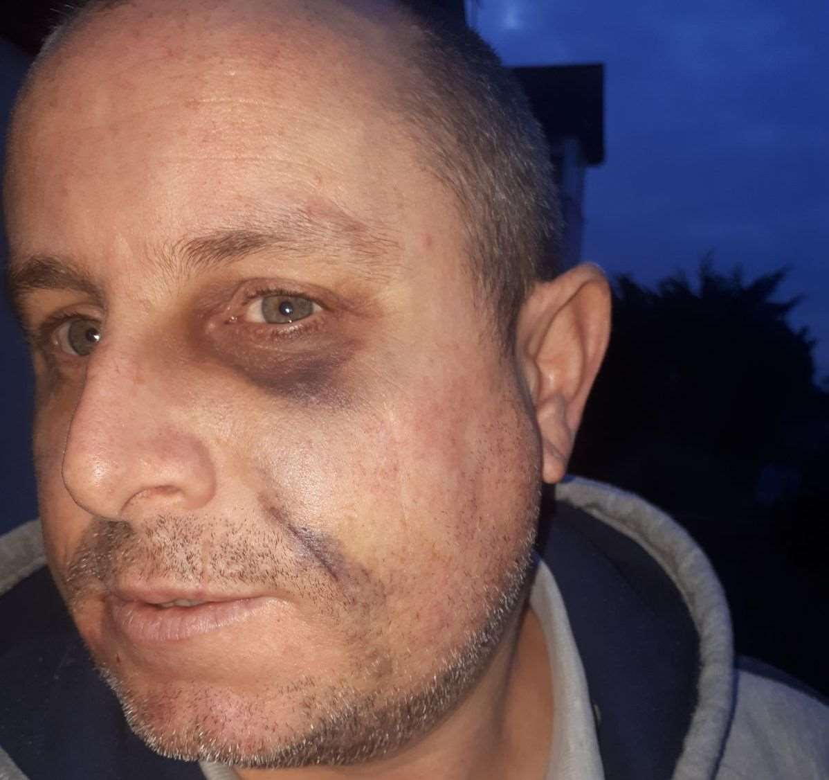 Luke Earl, the day after he was attacked (1221032)