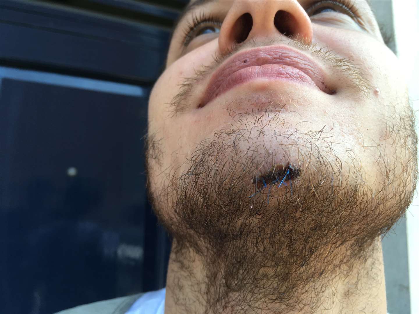 His chin was bleeding profusely after the group attacked him
