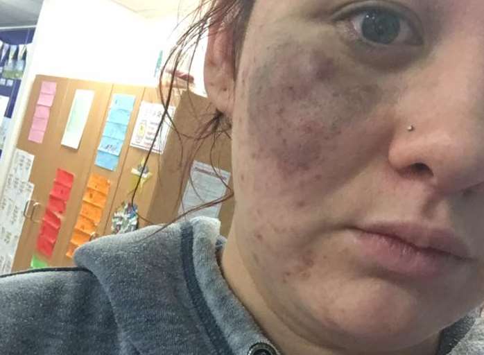 Lauren Croucher was left badly bruised in the attack