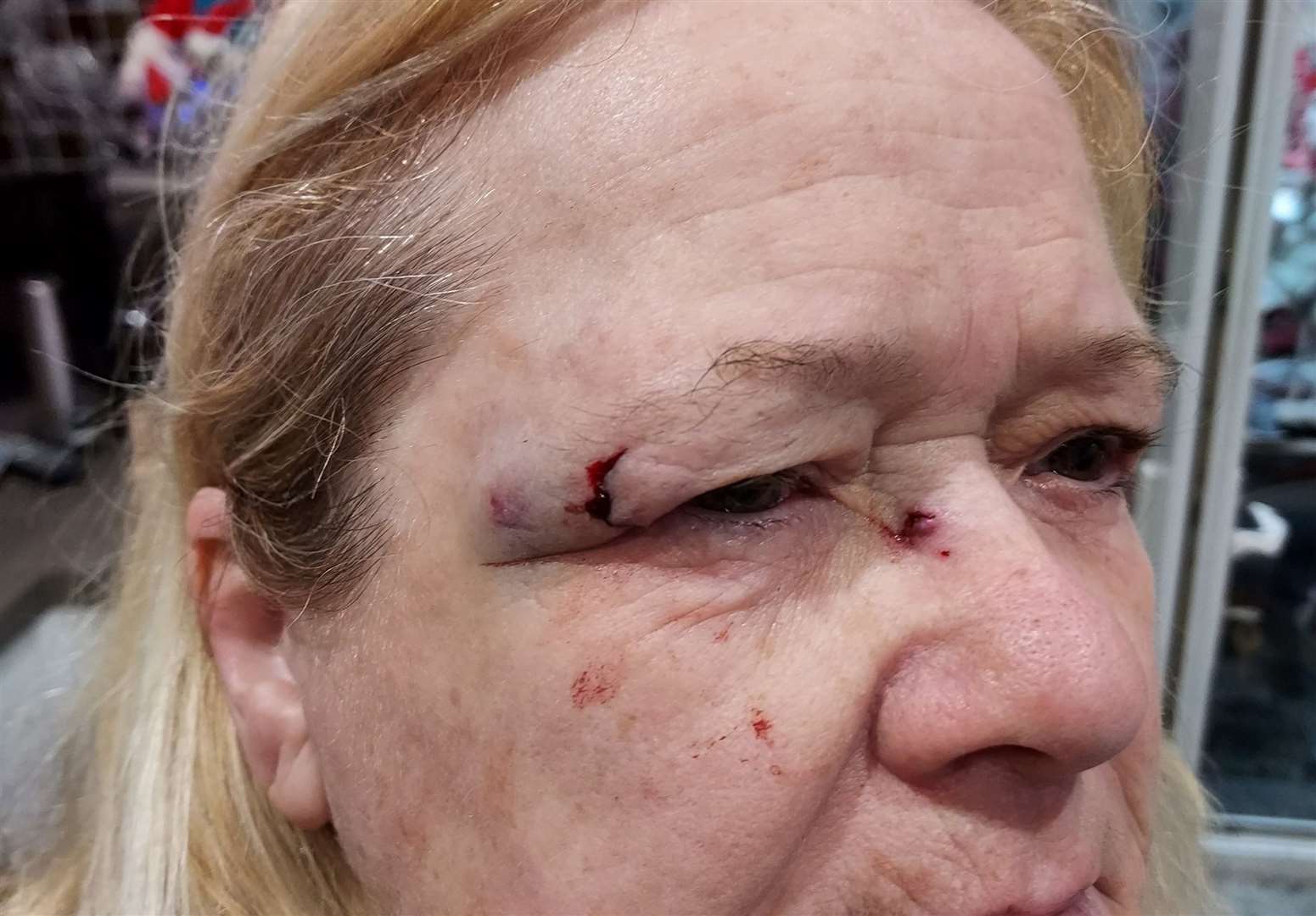 Angela Blacklocks suffered a cut and bruised eye