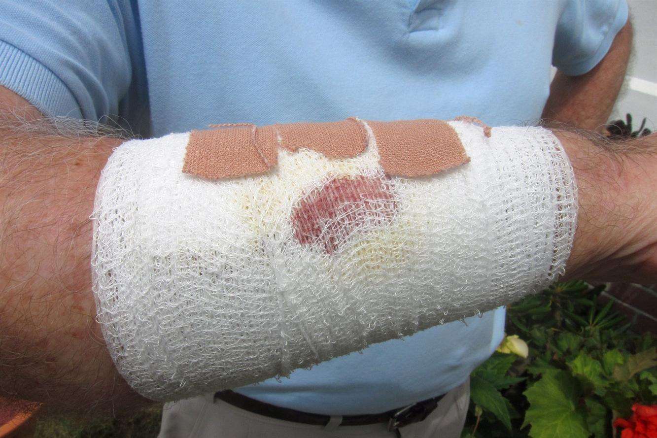 Bruce Gough's injured arm after being attacked by a stray cat