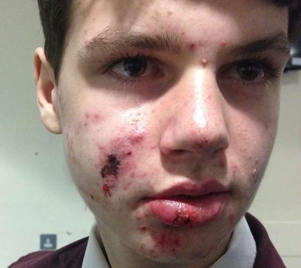 The battered face of Ethan Baber, 12, who was knocked down by a car at Queenborough Corner garage