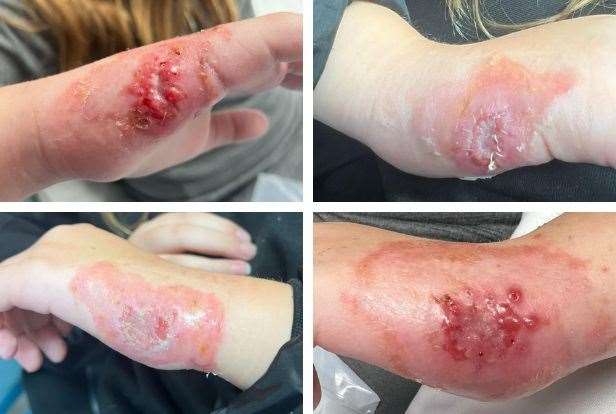 Chloe Norris' wounds.picture: Stacey Norris
