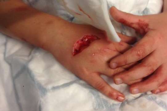 Six-year-old Annie Grant suffered a deep cut after crashing into the sign