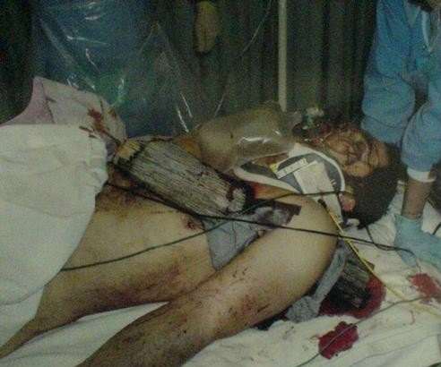 Peter Langdown lying on a hospital bed with a five foot fence post through his chest