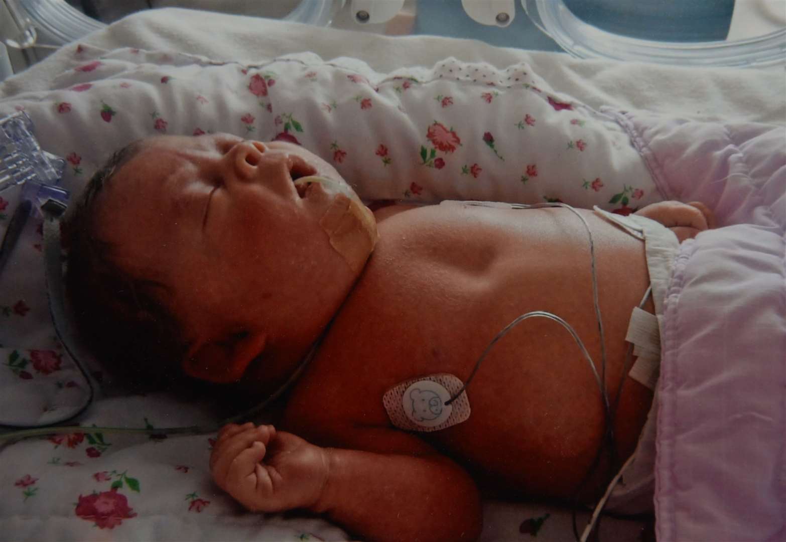 Katie had open-heart surgery when she was about eight weeks old