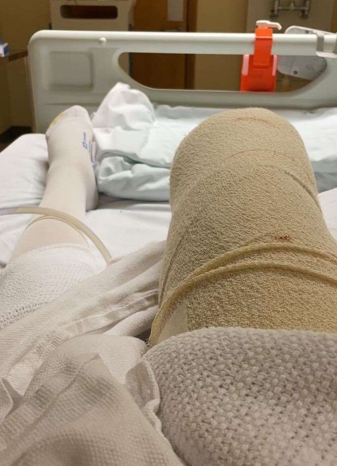 Amy Peterson had her lower right leg amputated in April this year. Picture: Amy Saward