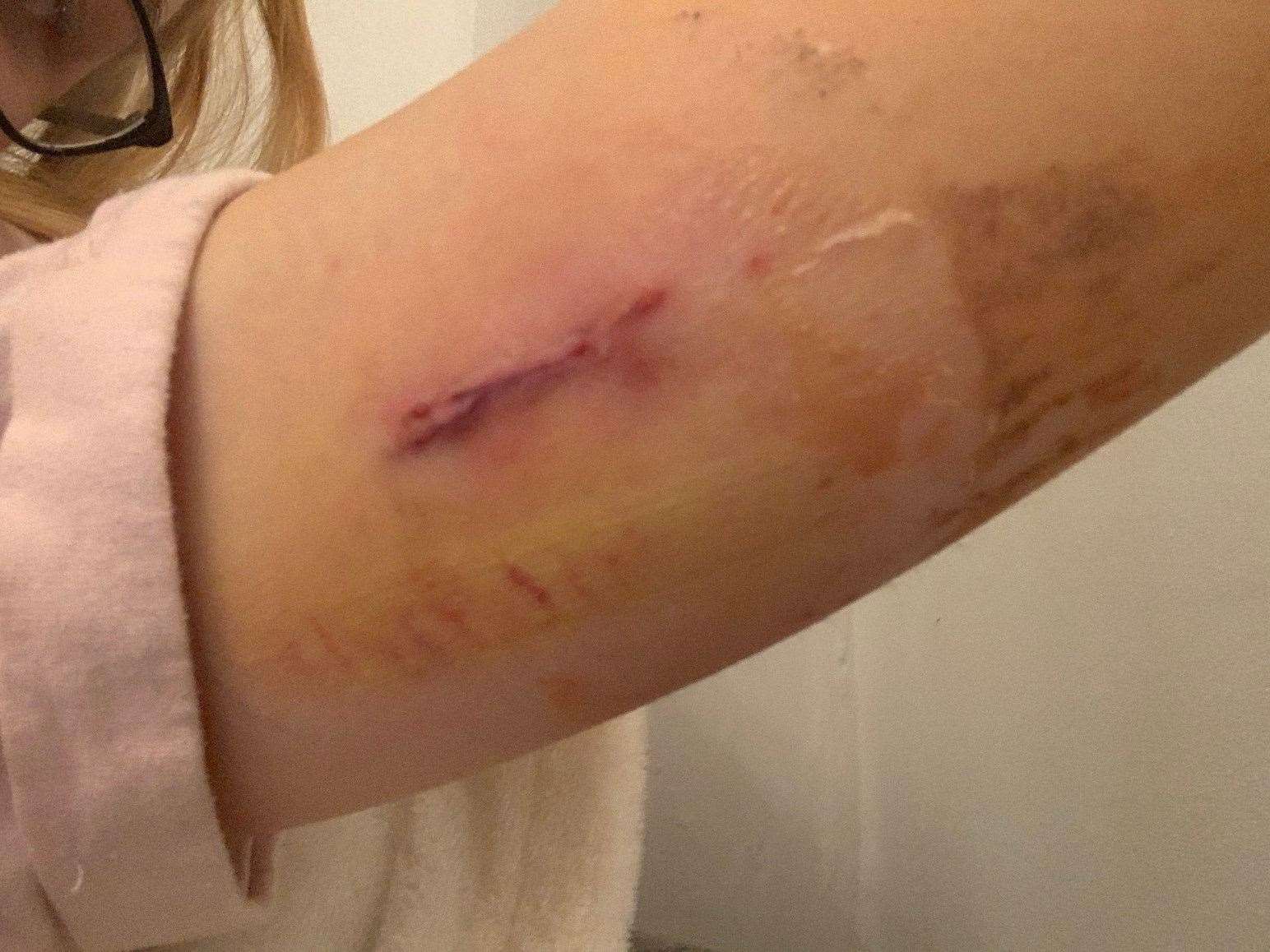 The implant is deep in her arm. Picture: SWNS
