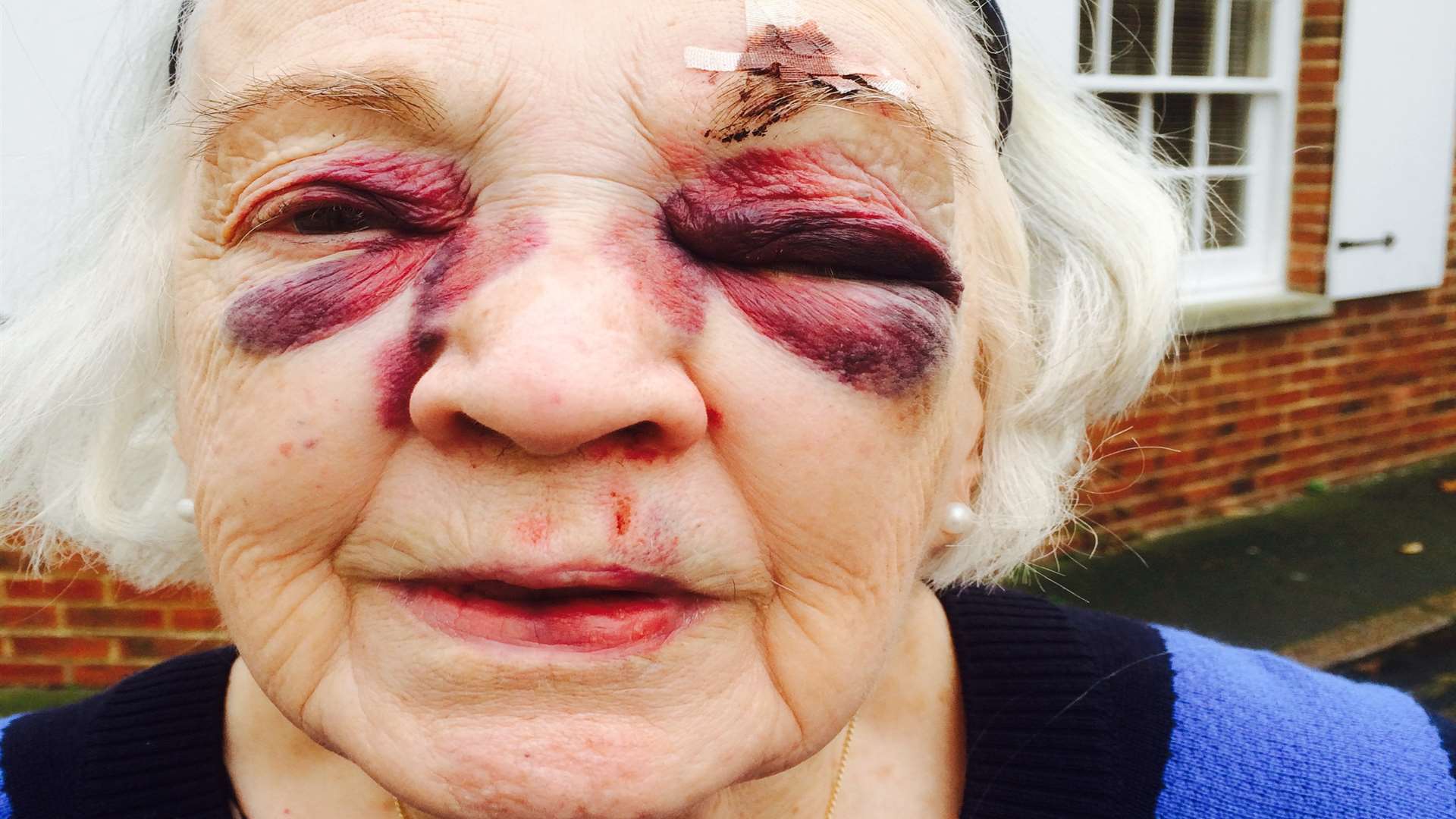 This elderly woman received stitches after a fall in Middle Street
